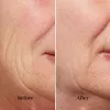 Aparelho silk'n FaceTite FTC1PE1001 tecnologia de rejuvenescimento da pele — lifting e contorno facial profissional