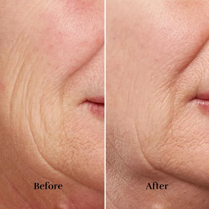 Aparelho silk'n FaceTite FTC1PE1001 tecnologia de rejuvenescimento da pele — lifting e contorno facial profissional