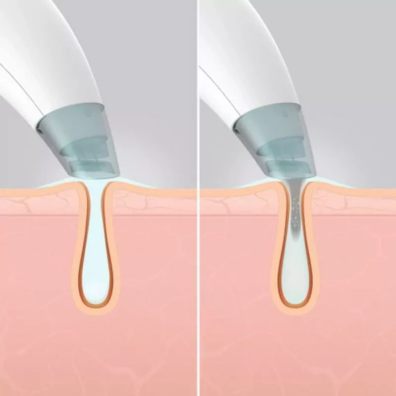 Aparelho de cuidados de pele HoMedics FAC-HY100 hidradermabrasão limpador transparente, branco